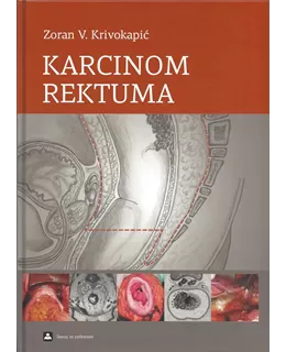 karcinom_rektuma
